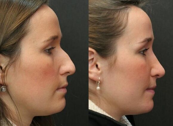 Virun an no net -Surgical rhinoplastesch