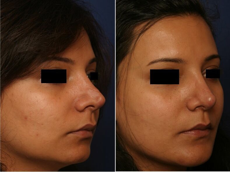 Resultat vun Plastesch Chirurgie