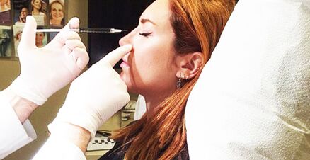 Rhinoplastik Prozedur mat Filler