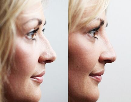 Virun an no Rhinoplastik mat Filler