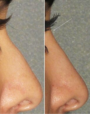 Virun an no net-chirurgeschen Rhinoplastik