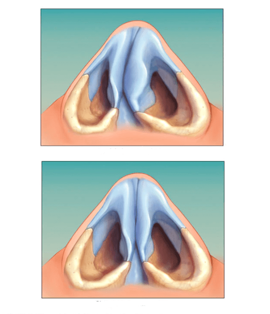 korrigéiert nasal septum