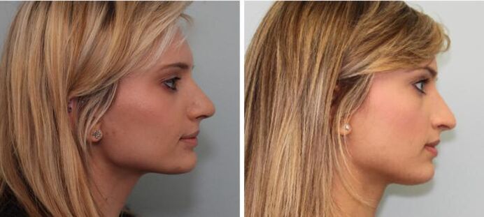 Rhinoplastik Resultater virun an no