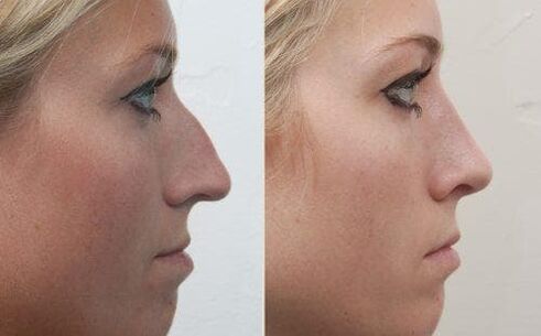 Virun an no net-chirurgeschen Rhinoplastik