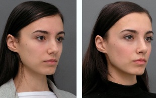 Meedchen virun an no Rhinoplastik Nues